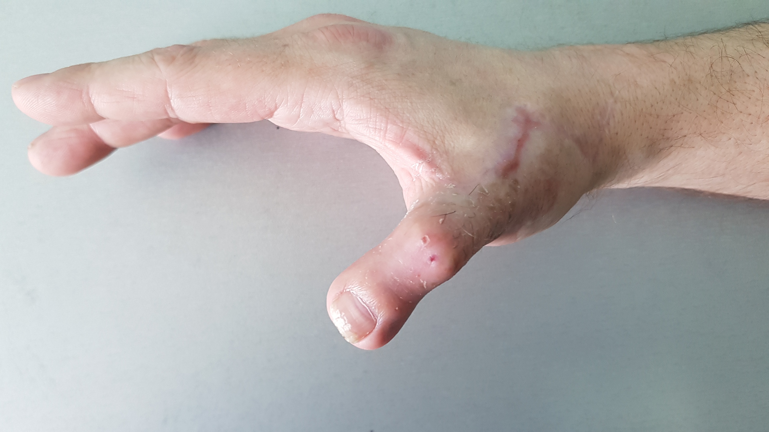 Хирурги перешили жителю Пензы палец с ноги на руку спустя 30 лет после травмы