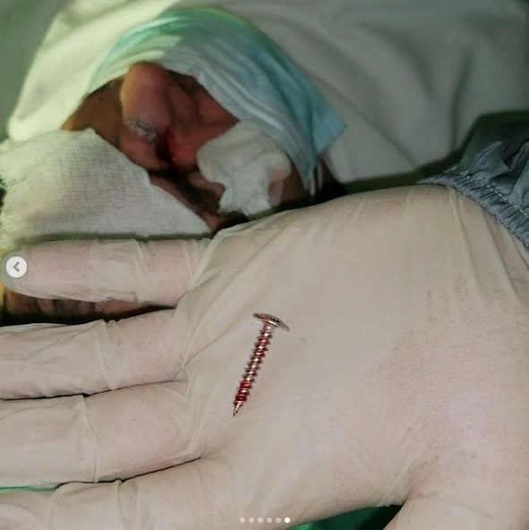 В Пензе к врачам обратился мужчина с саморезом в носу