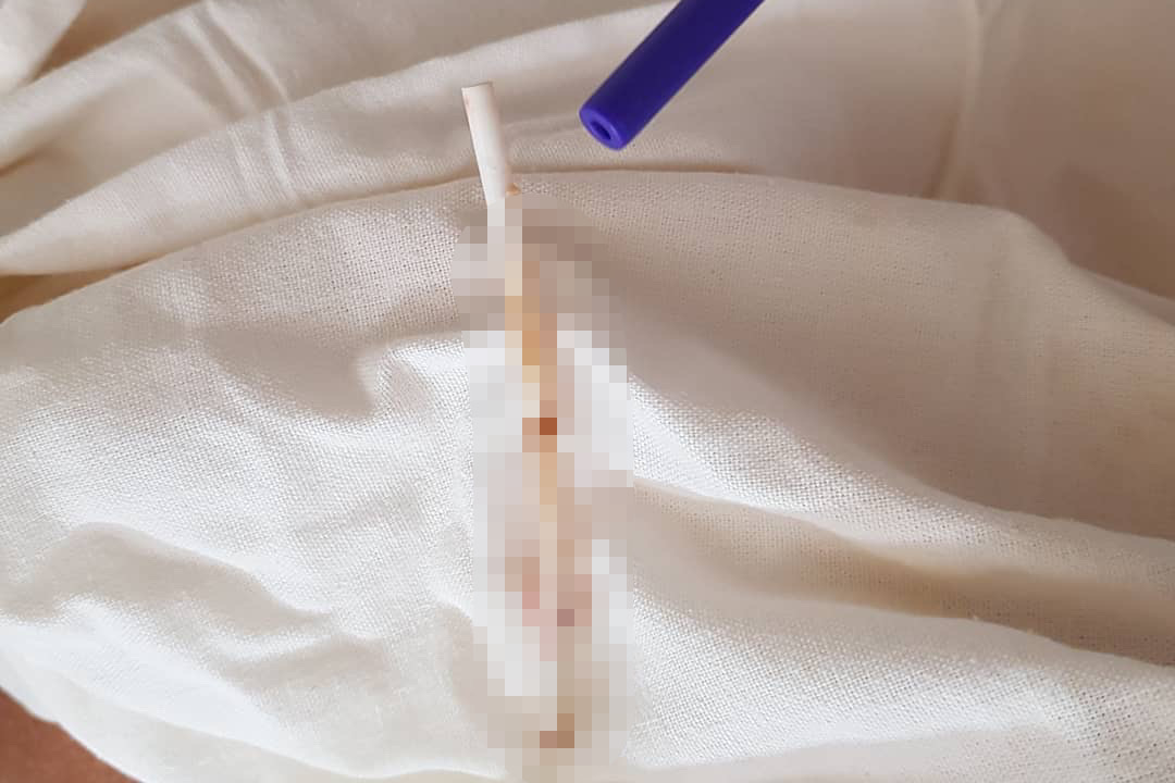 Врачи извлекли из мочевого пузыря пензячки палочку от леденца