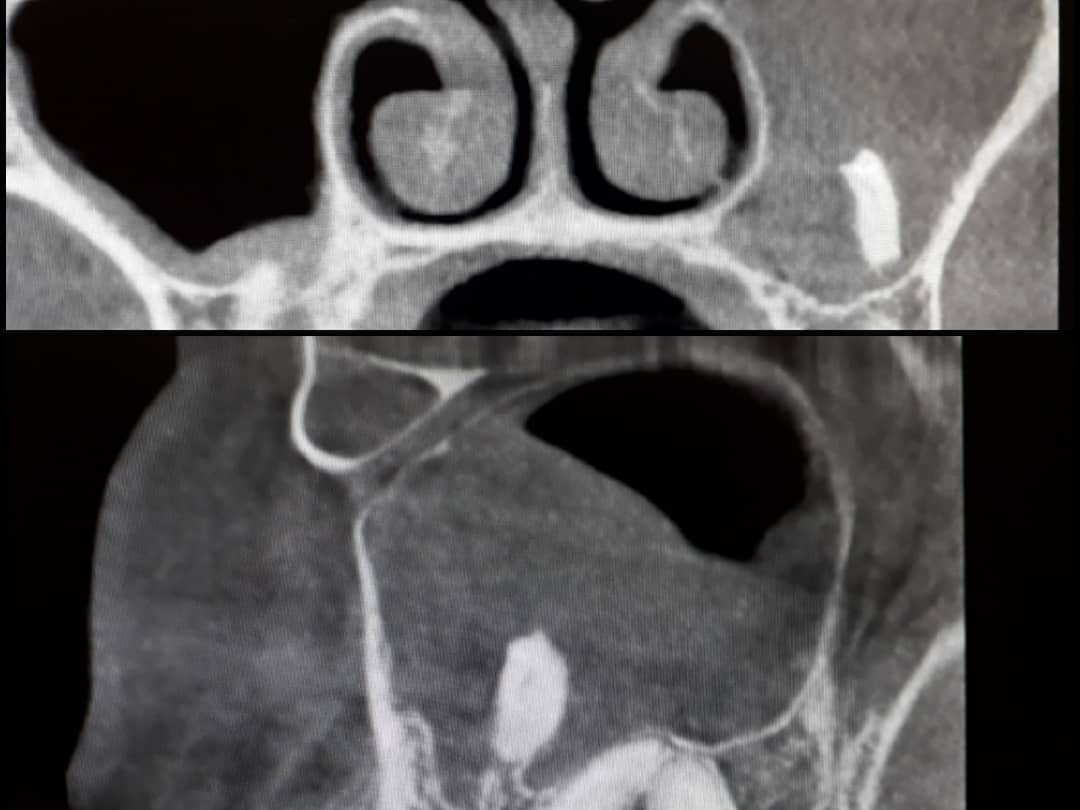 Врачи рассказали о сложном удалении зуба пензенца