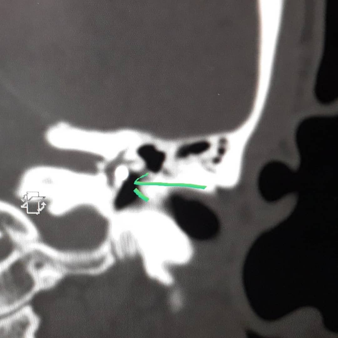 В Пензе врачи нашли у пациента за барабанной перепонкой металлические осколки