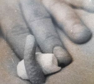 В Сердобске врачи поделились фотографиями «хвостатого» человека