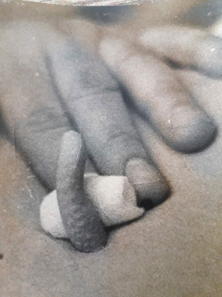 В Сердобске врачи поделились фотографиями «хвостатого» человека