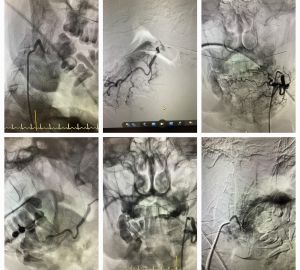 В Пензе медики провели экстренную операцию пациенту с кровотечением опухоли шеи
