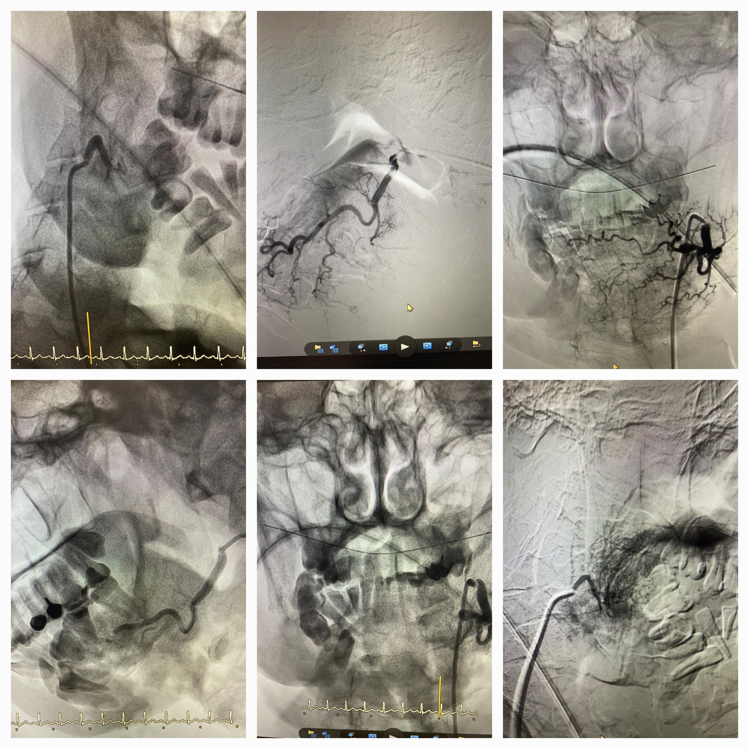 В Пензе медики провели экстренную операцию пациенту с кровотечением опухоли шеи