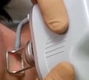 В больницу Бурденко поступил современный лазер для омоложения кожи