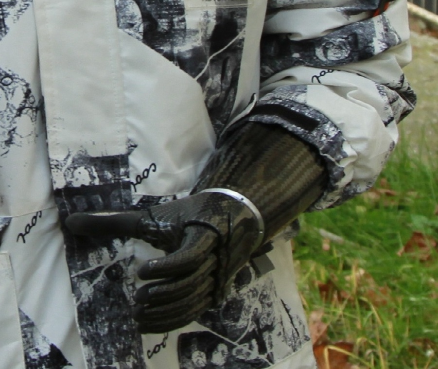 В Пензе ребенок-инвалид получил протез предплечья с микропроцессорным управлением