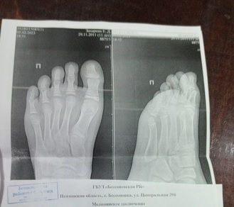 В Бессоновке мальчик со сломанной ногой ползком добирался до рентген-кабинета