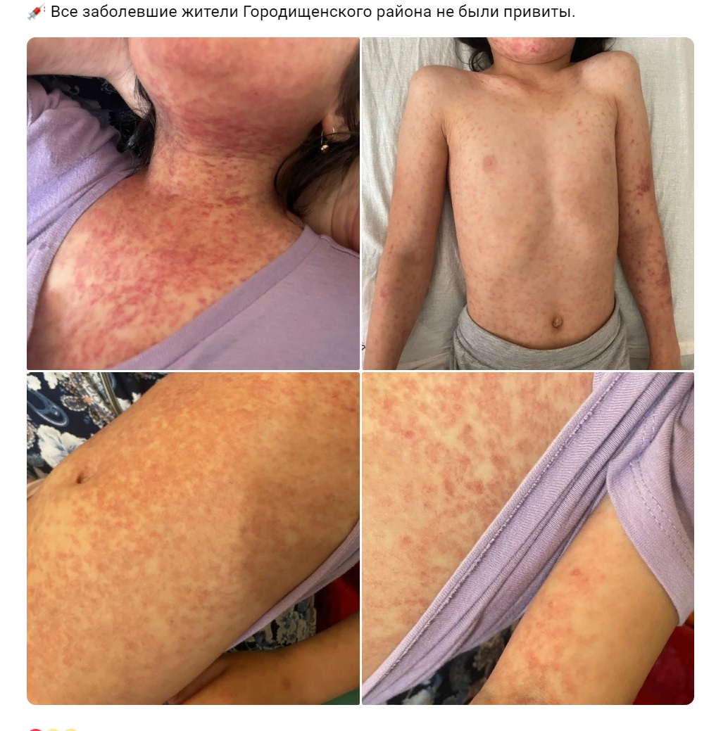 Пензенцам показали снимки детей, изуродованных смертельной корью