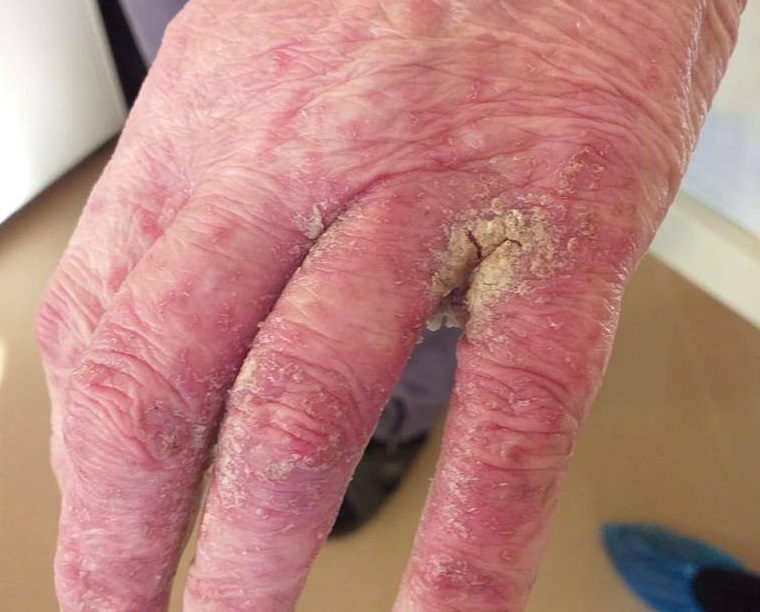 Пензенские медики показали как выглядит женщина, страдающая от норвежской чесотки