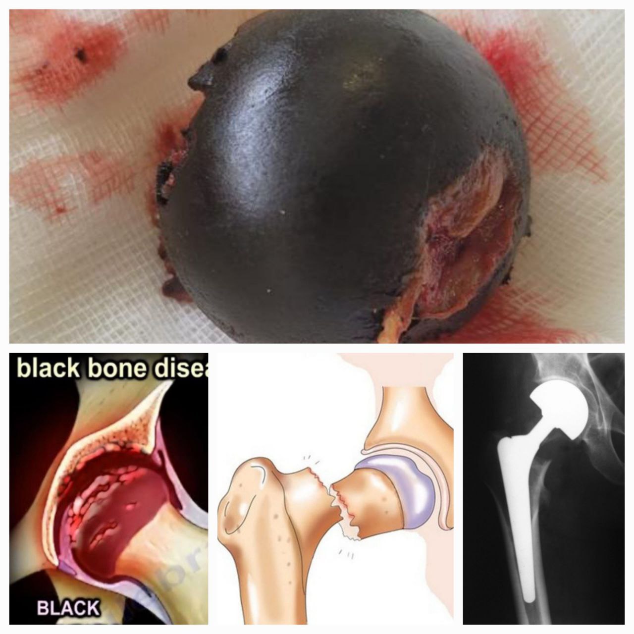 Пензенские травматологи столкнулись с редким заболеванием