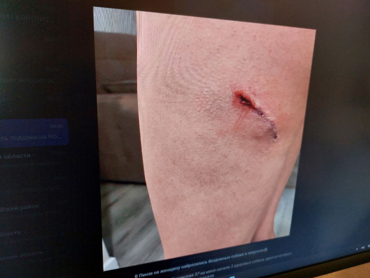 Пензячка рассказала, как на улице Ладожской ее покусали собаки