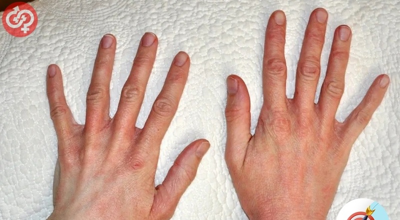 Пензенцам назвали симптомы холодового дерматита