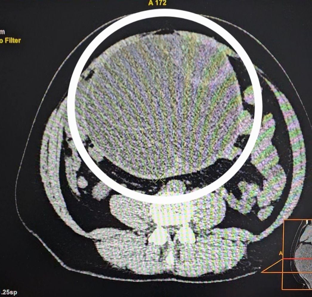 В Заречном у женщины вырезали из брюшной полости гигантскую опухоль