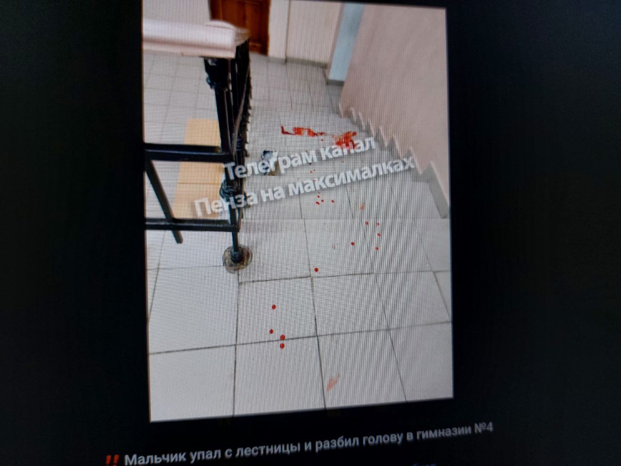 В Пензе 10-летний мальчик получил переломы, упав с лестницы в школе