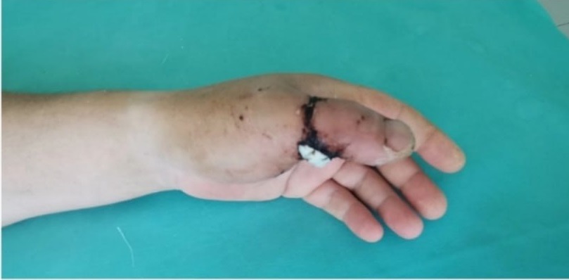 Врачи Захарьинской больницы в Пензе вернули мужчине отрезанный болгаркой палец