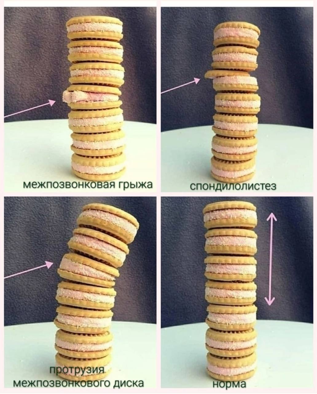 Пензенские медики показали позвоночник больного человека на примере фото с печеньками