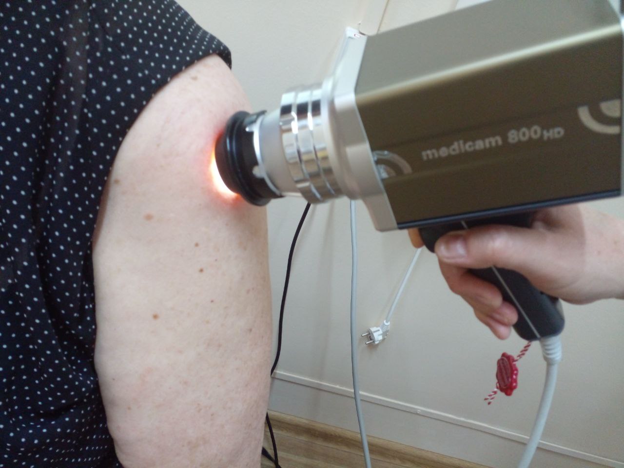 Пензенский дерматолог рассказал, когда родинки могут быть опасны