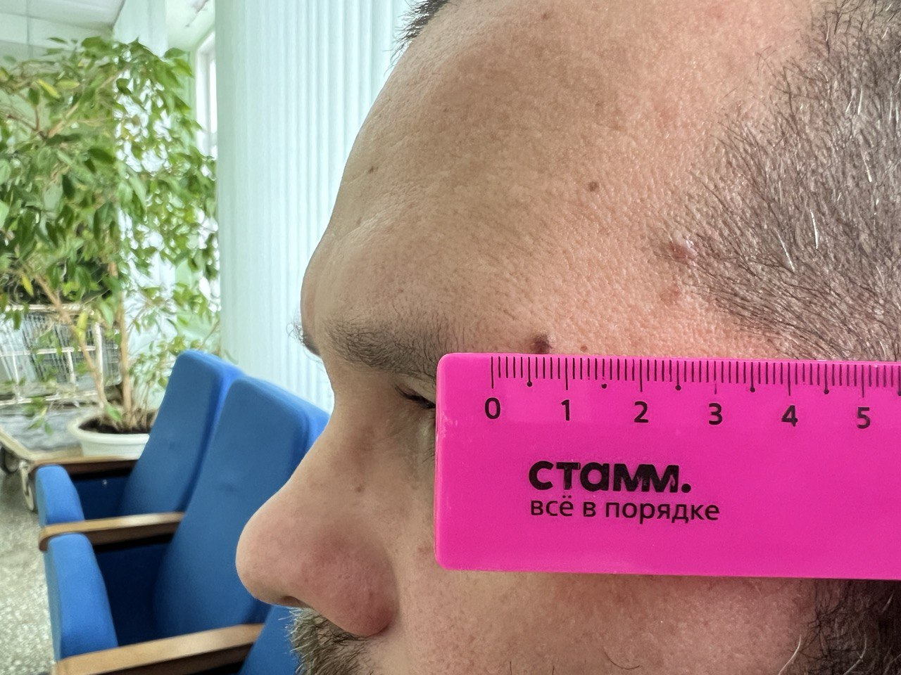 Пензенцев приглашают на бесплатную диагностику рака кожи