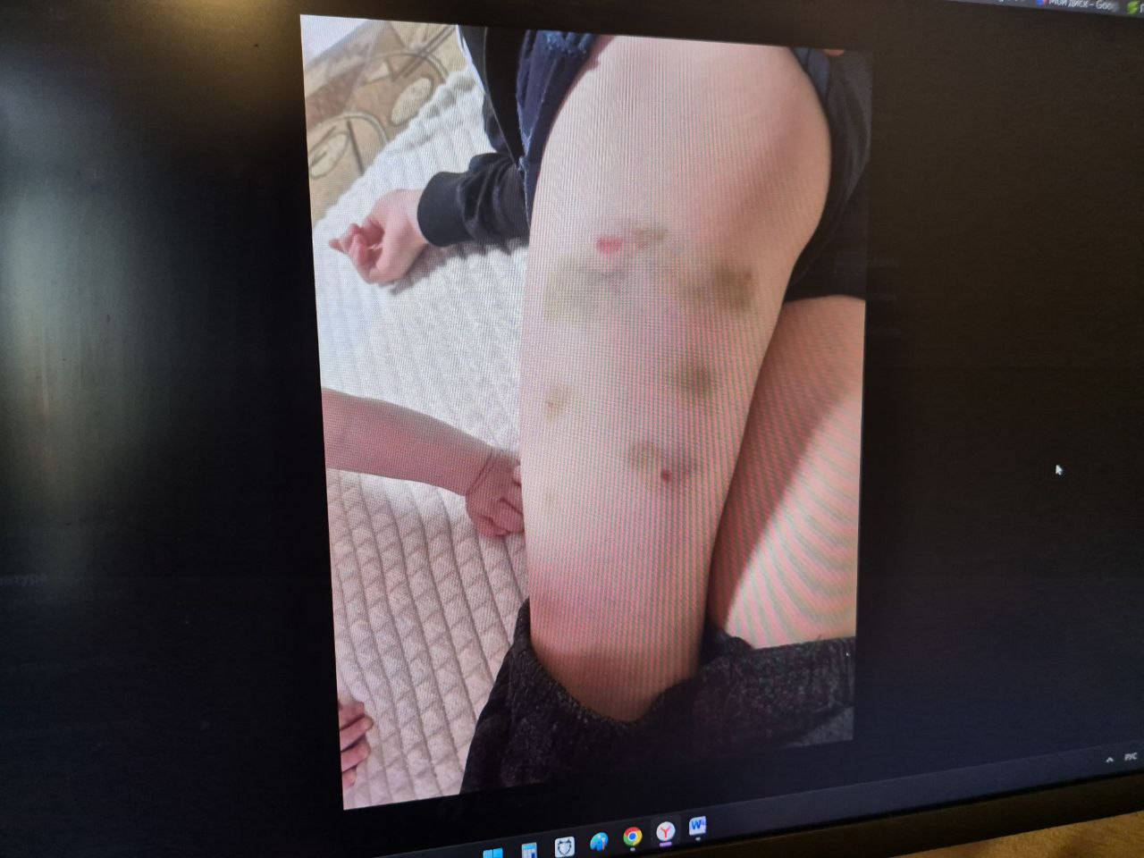 Пензенцы рассказали о ребенке, покусанном шестью собаками у школы №20