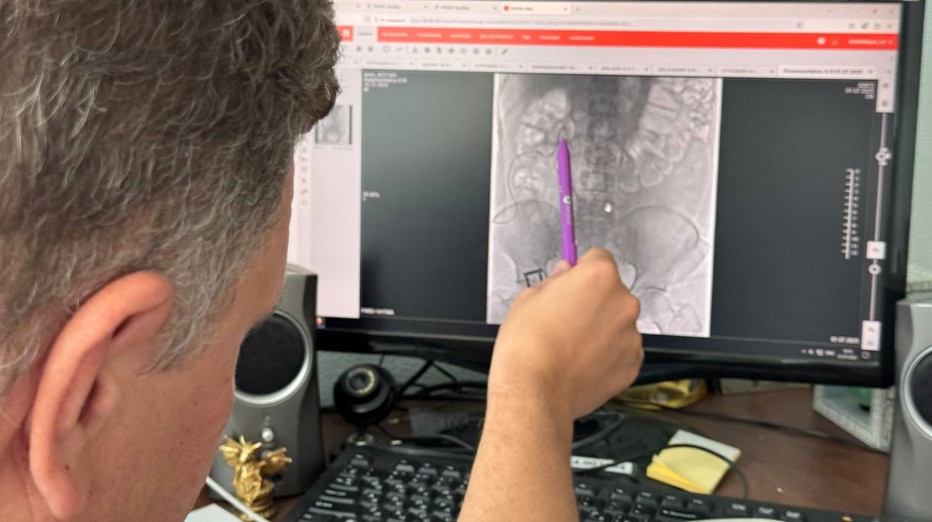 Пензенские врачи провели уникальную операцию на почке