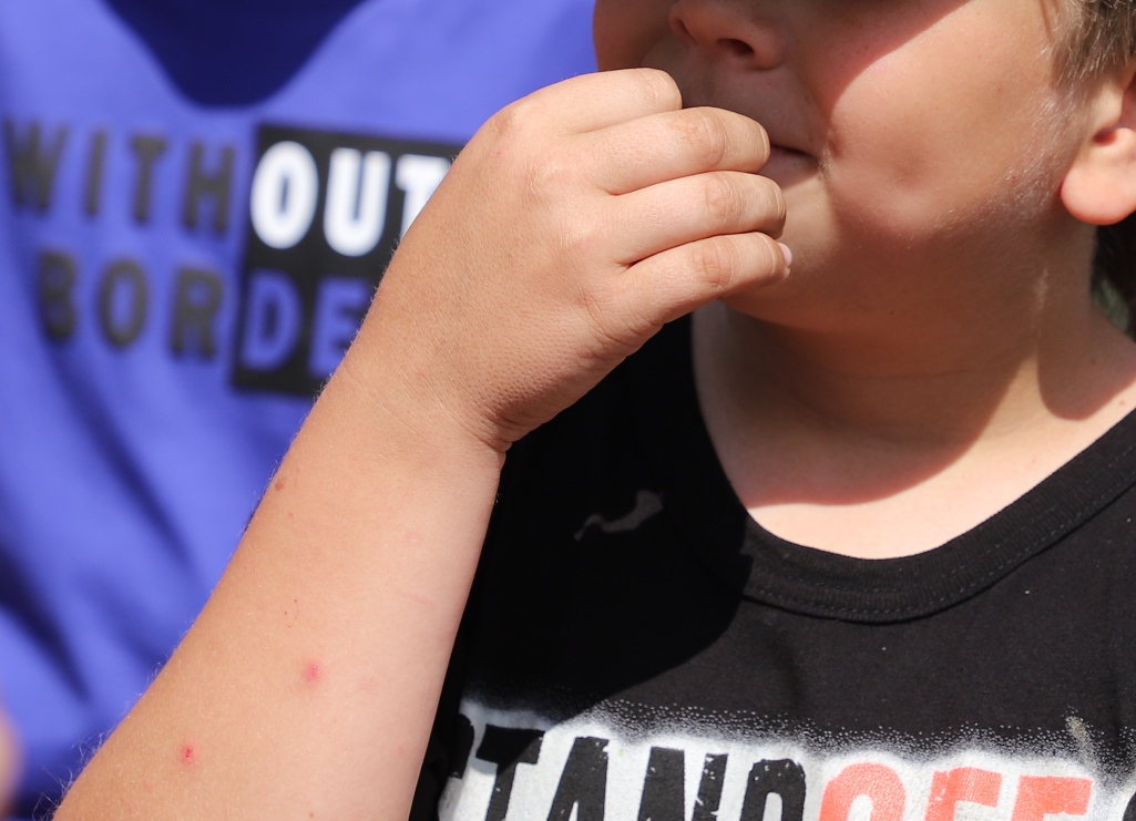 Пензенский врач: вредные привычки у детей грозят стоматитом и гельминтами