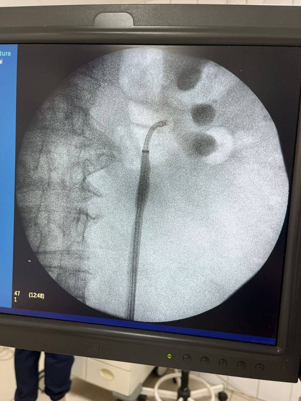 В Пензе провели уникальную операцию пациентке с вколоченным камнем мочеточника