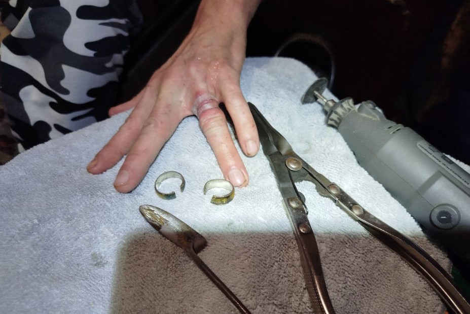 В Пензе спасателям пришлось разрезать кольца на опухшем пальце мужчины